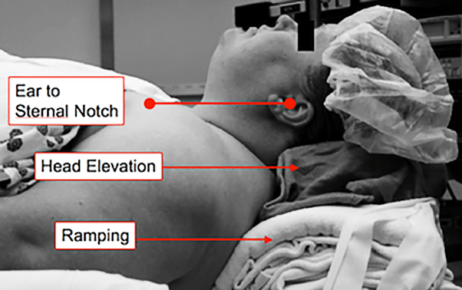 Intubation Sniffing