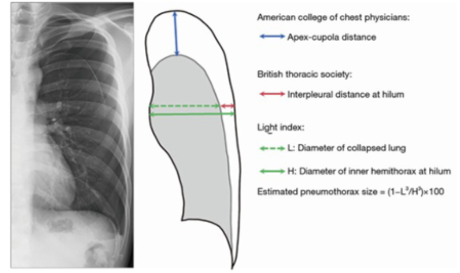 Mesure du pneumothorax