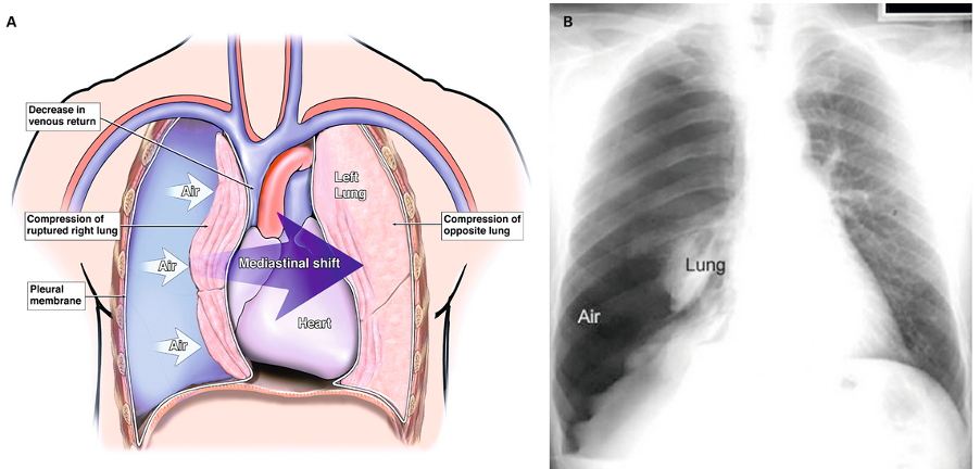 Pneumothorax sous tension